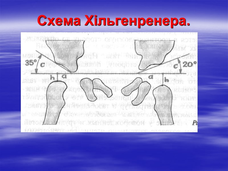 Схема Хільгенренера.